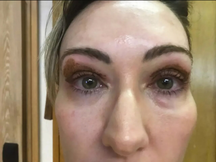 Безоперационная блефаропластика Jett Plasma Lift Medical