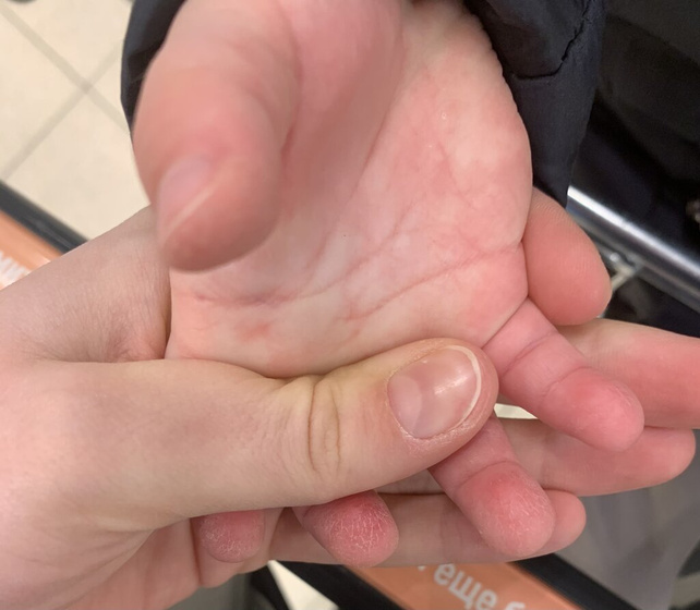 Синюшные пятна