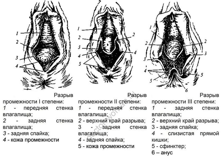 Промежность и разрывы