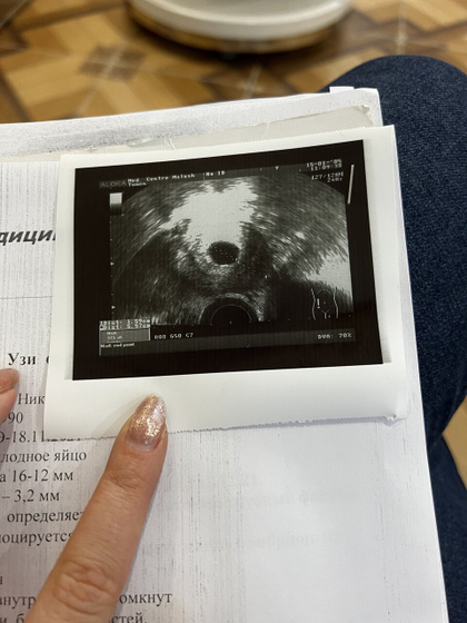 Первое узи