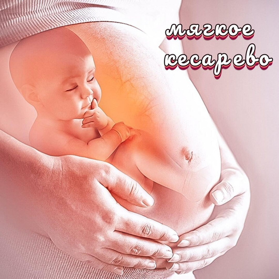 Мягкое кесарево