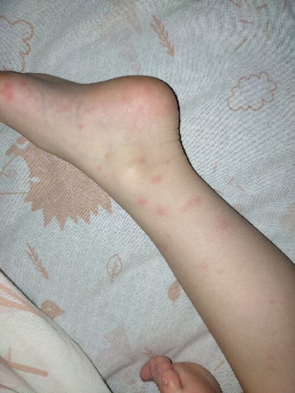 Сыпь.
