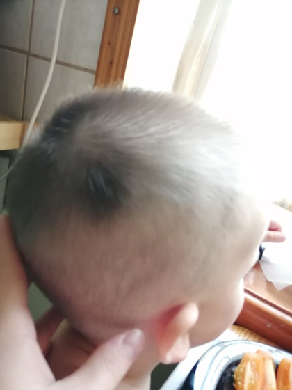 У старшего сына волосяной