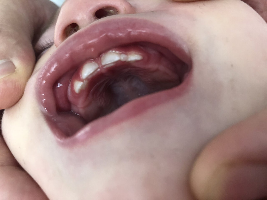 Похоже у ребёнка растёт второй ряд зубов