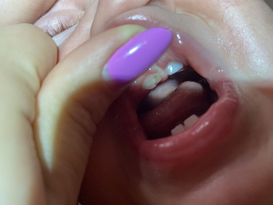 Лечение молочных зубов под севораном