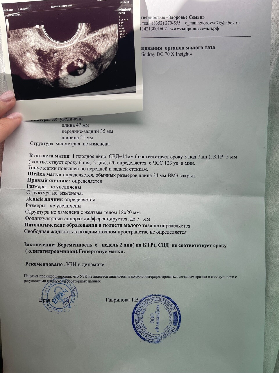 Плодное яйцо отстает от эмбриона